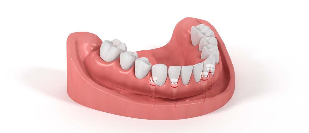 1. Sistema Straumann Mini Implants Il sistema Straumann Mini Implants offre impianti Tissue Level monopezzo con connessione protesica Optiloc.