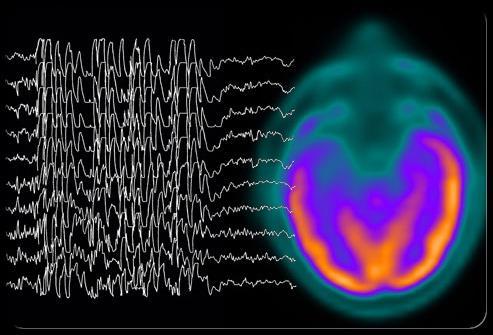 Un EEG può confermare la diagnosi e offrire ulteriori informazioni sulla crisi. Questa procedura indolore registra l'attività elettrica del cervello.