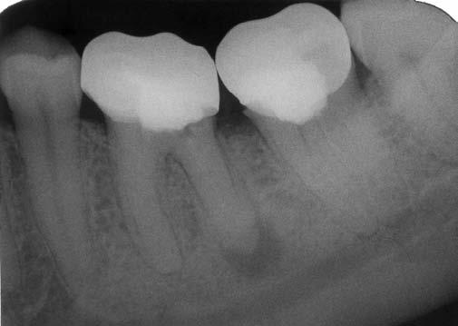 Caso clinico 34 Paziente: C.M.E. - anni 36 Sesso: F Elementi dentari interessati 36 Pulpite acuta Prodotto utilizzato Endocalex (Endocalex 6-9) Amoxicillina x os: cpr.