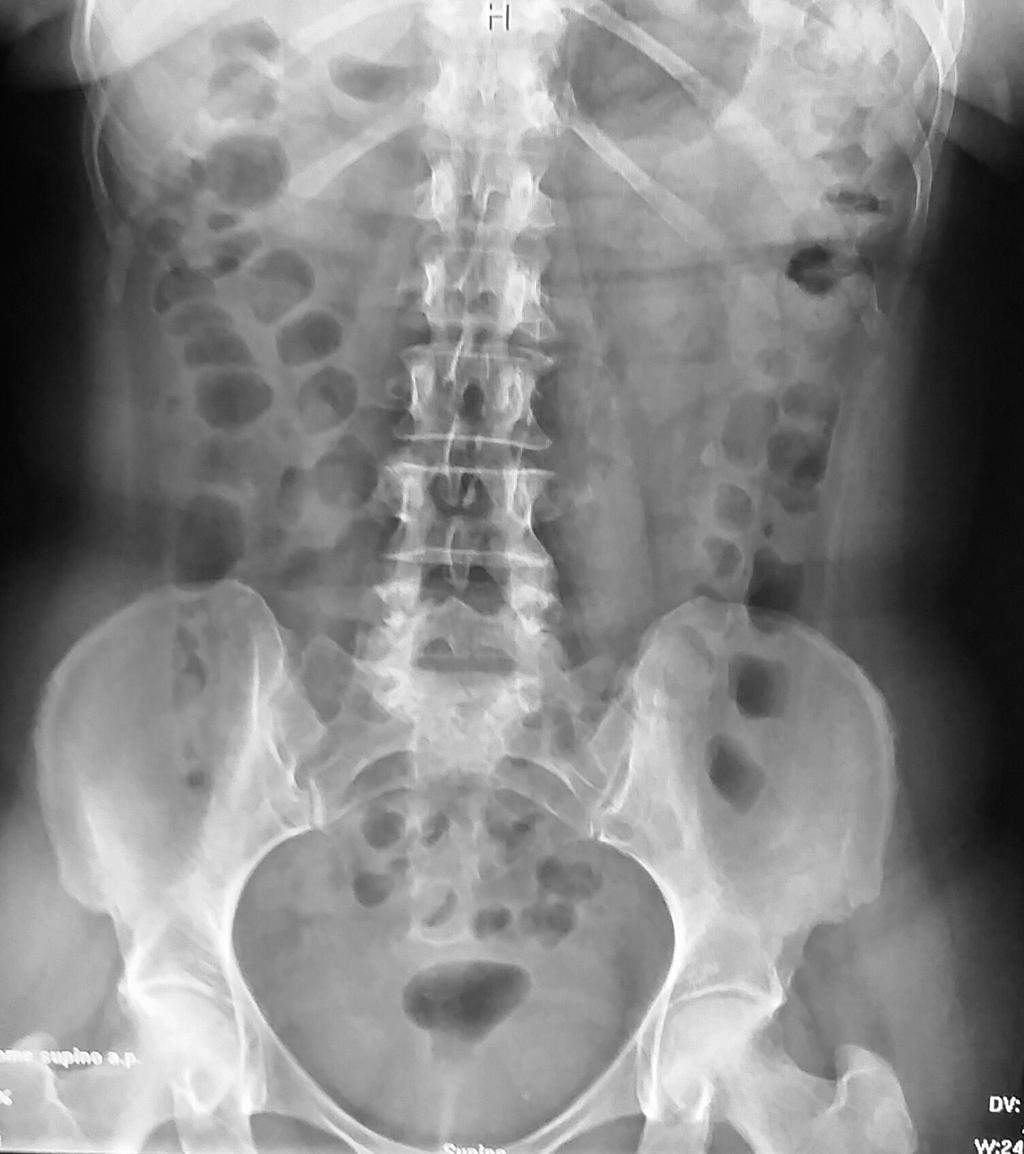 PROIEZIONE ANTERO-POSTERIORE A PAZIENTE SUPINO INDICAZIONI= Ricerca di calcoli o calcificazioni nei reni (colica renale), meteorismo.