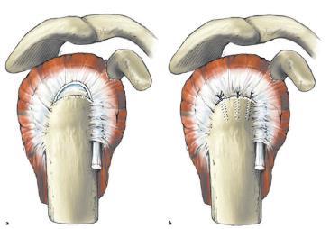shaped Side to Side Tendon