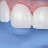 1 % 60 ottima buona modesta insufficiente 50 40 30 20 76.9 % La buona lucidabilità è stata confermata dai dentisti.