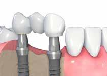 Tissue Level Ponte Cementato Usando RN come esempio Presa d impronta 2 Realizzazione del modello