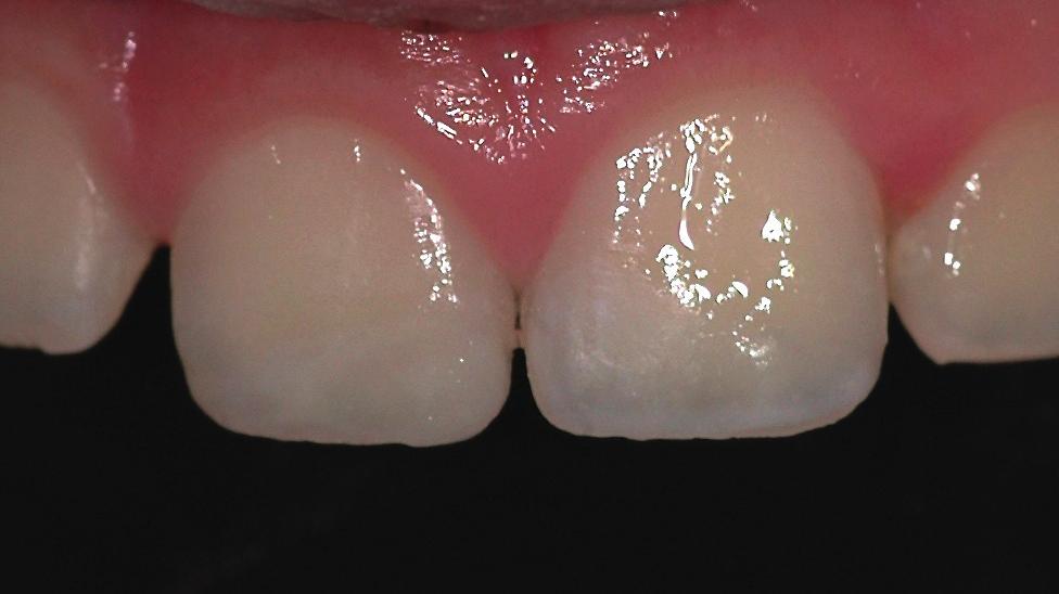 1 fratturati in seguito a trauma ➌ sistema adesivo smalto-dentinale CLEARFIL
