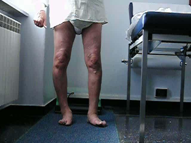 Caviglia dolorosa degenerativa zoppia dolore limitazione