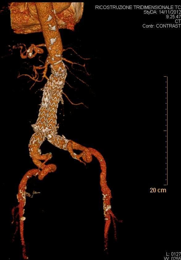 CHIRURGIA ENDOVASCOLARE : PRO E CONTRO Ridotta invasività Riduzione dei tempi operatori Non ricorso ad emotrasfusioni Riduzione dei tempi di ospedalizzazione Tempi di recupero più rapidi per il