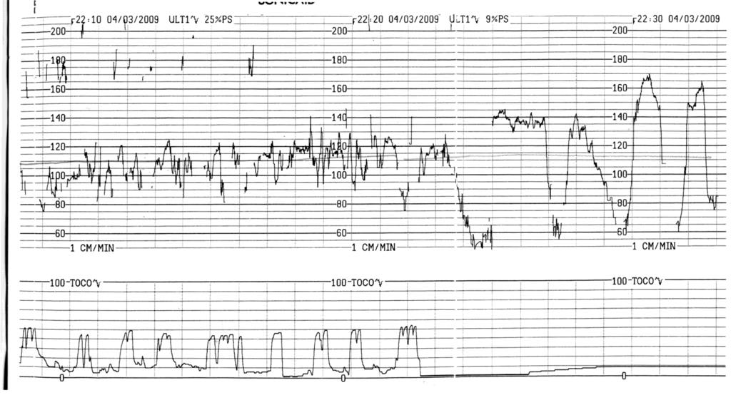 ventosa 3 traz ESEMPIO CTG pat: per esp Tipo 2B SB PVO occ post gr 3360 apgar 6-9 40.3w ph 6.96 BE -13.