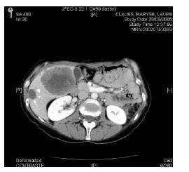 Marzo 2007: si mantiene la stabilità volumetrica delle lesioni,