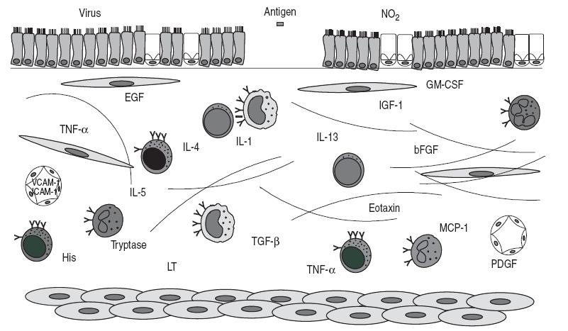 IL-5 e PATOLOGIE: ASMA ASMA: disordine infiammatorio cronico della mucosa delle vie respiratorie. La patologia si presenta in 2 stadi: 2.