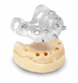 STRUMENTAZIONE CHIRURGICA Pin di fissaggio e frese Quando non sia possibile stabilizzare la dima chirurgica sui denti residui, è opportuno adottare un protocollo con lembo a spessore totale che