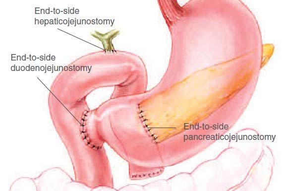 Whipple pancreatic head resection