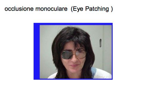 EYE PATCHING e HEMIBLINDING L eye-patching consiste nell occlusione, attraverso l uso di una benda, dell occhio destro o dell occhio sinistro del paziente, oppure dell occlusione di un intero