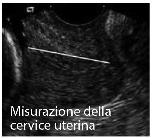 CERVICOMETRIA 16-23 SETTIMANE Si tratta di un esame eseguito per via transvaginale allo scopo di misurare la lunghezza del collo uterino tramite la quale si ha la capacità di riconoscere molti dei