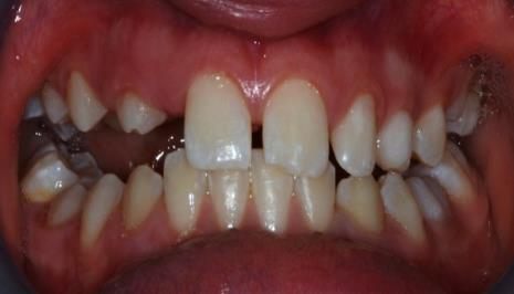dell'infraocclusione dei seguenti elementi dentali: 54, 55, 64, 65, 74, 75,
