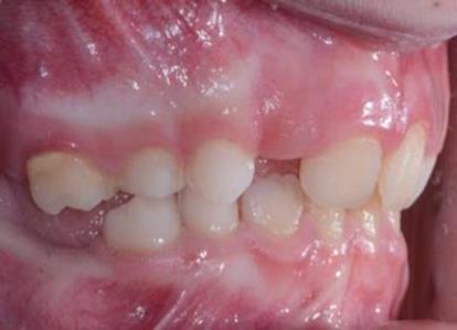 I denti interessati dall'anomalia eruttiva sono i seguenti: 75, 85, 16, 26, 36, 46.