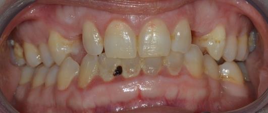 dentali per alterato tragitto eruttivo: 13, 23 e 35. Anche in questo caso è stata riscontrata la medesima variante nell'esone 16 c. 1765 T>C p.589 W>R. Variante nell'esone16 c.