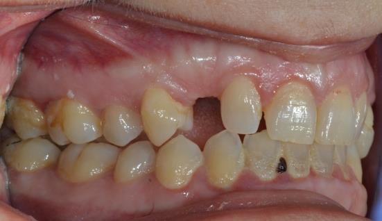 589 W>R), aminoacidi con diverse caratteristiche chimiche; tale variante cade all interno del dominio citoplasmatico funzionale della proteina PTH1R, coinvolto nell interazione