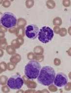Parlando di Leucemia Mieloide Cronica Storia naturale della LMC: le 3 fasi Fase cronica Fase