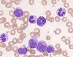 Parlando di Leucemia Mieloide Cronica Cromosoma Ph 95% delle LMC