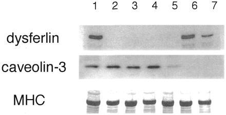 Analisi immunoblot delle biopsie muscolari dei pazienti con MM, LGMD2B, e LGMD1C.