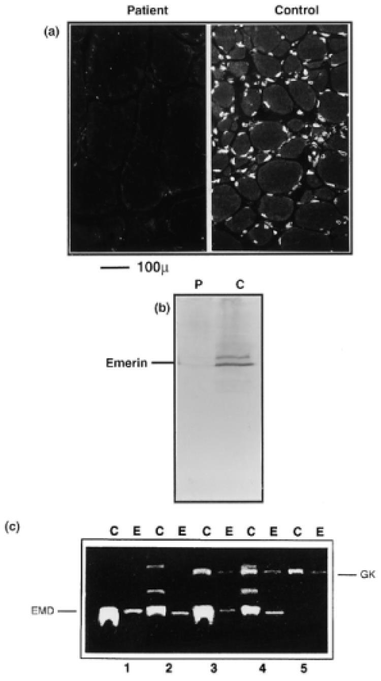 ITER DIAGNOISTICO COMPLETO Proteina emerina ed espressione dell mrna nel muscolo di paziente EDMD X-linked con delezione dell emerina