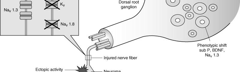 Aumento della sensibilità dei neuroni del corno posteriore del midollo spinale (farmaci bloccanti i recettori NMDA del glutammato) 4.