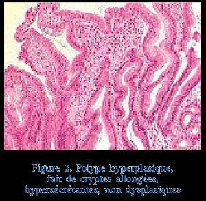 Asintomatici Diagnosi occasionale Si formano per un incremento dei processi proliferativi a livello della metà