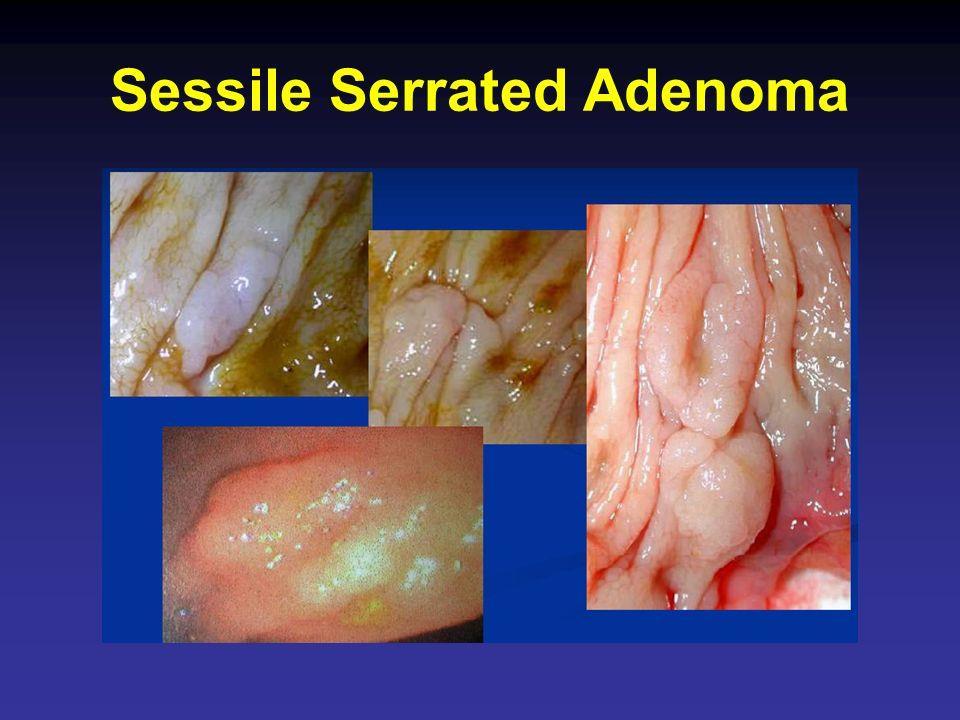 Adenomi serrati sessili Gli adenomi serrati sessili (adenoma serrato di tipo superficiale,