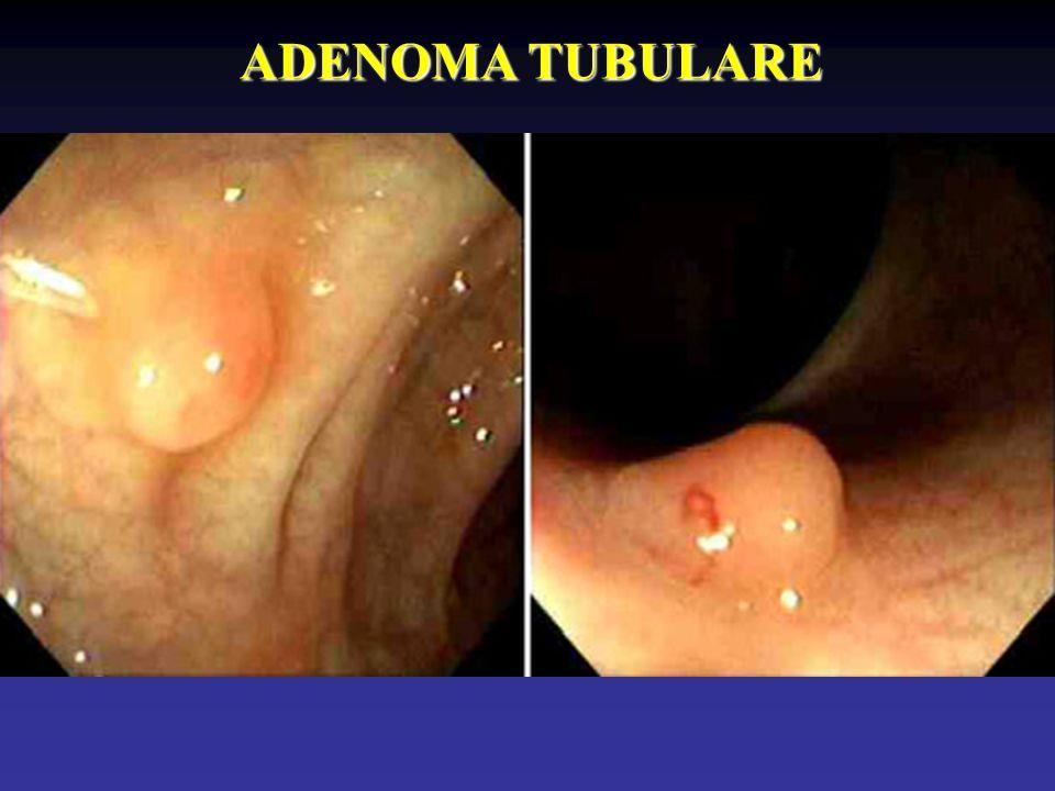 Adenomi tubulari Gli adenomi tubulari mantengono l architettura originale delle cripte, seppur in presenza di atipia