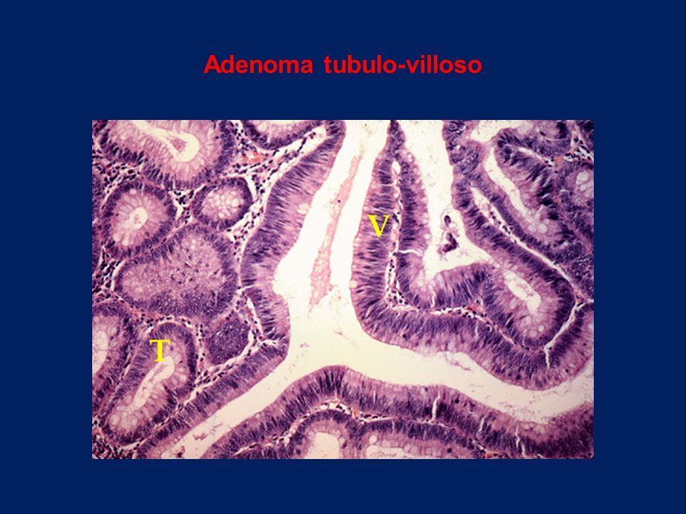 Adenomi tubulo-villosi Gli adenomi tubulo-villosi sono costituiti da istotipi con elementi tubulari e villosi associati, in cui la componente villosa varia tra il 25 ed il 75%.