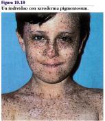 Xeroderma Pigmentosum Autosomica recessiva. 1/250.000 (Western countries) - 1/40.