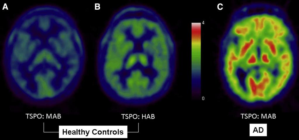 IN VIVO PET con [11C]-PBR28 per attivazione