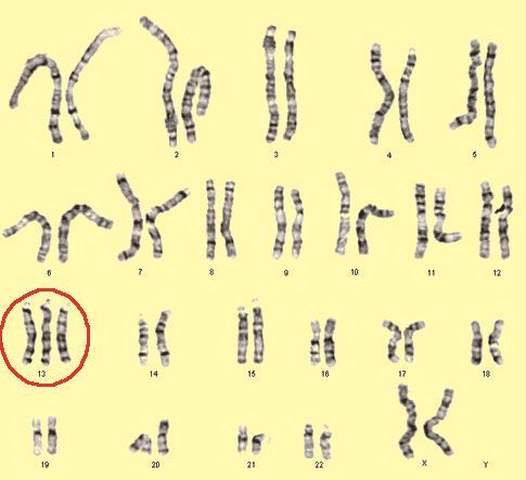 (sindrome di Patau) Il test cff-dna può anche rilevare anomalie numeriche dei cromosomi sessuali, come la