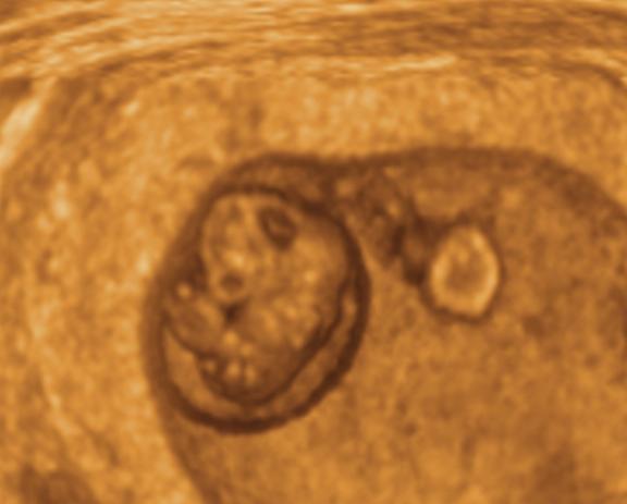 Ruolo dell ecografia prenatale esperta L esame ecografico esperto consente di diagnosticare: - i casi con