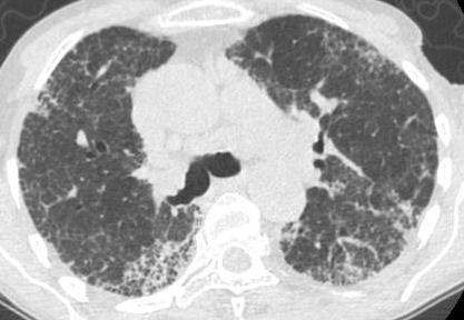 TC torace HR: avanzata della malattia fibrosante con grossolane reticolazioni fibrotiche in associazione a micro lesioni cistiche