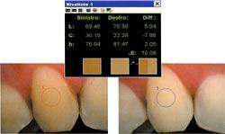 Risultati SpectroShade fornisce una valutazione generale del colore del dente una valutazione nelle