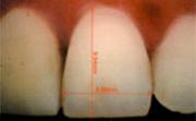 Misura Analizza lunghezza del dente misurando in centesimi di millimetro.