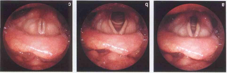 Rima della glottide fonazione- inspirazione forzata- respirazione Nella laringe: epitelio