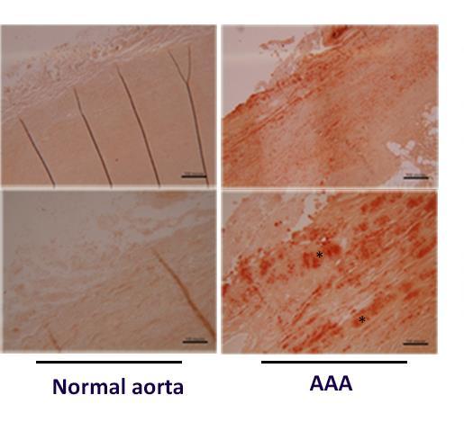Choke E et al. Abdominal Aortic Aneurysm Rupture Is Associated With Increased Medial Neovascularization and Overexpression of Proangiogenic Cytokines.