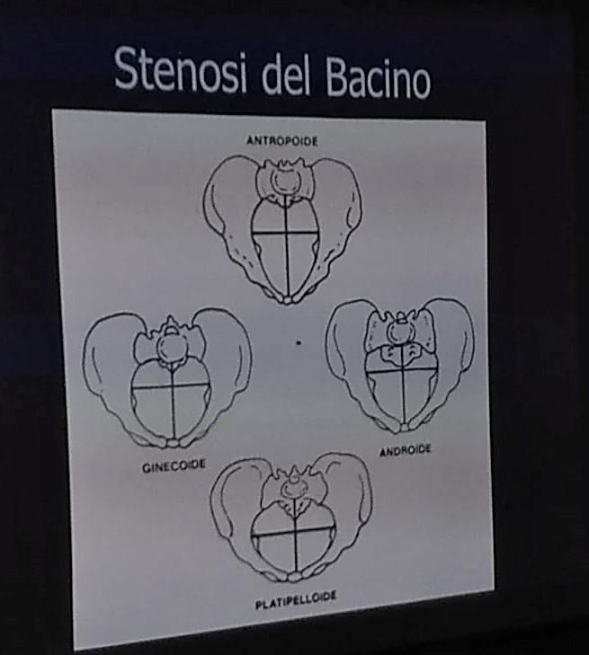 parto. Se ciò avviene vuol dire che il corpo mobile riuscirà con molta probabilità ad attraversare il canale. ESEMPI DI BACINI STENOTICI.