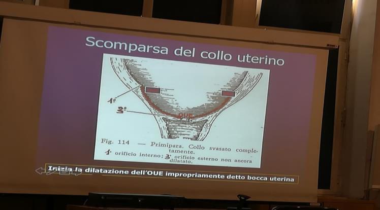 corrispondenza dell ombelicale trasversa è un segno di prossima rottura d utero.