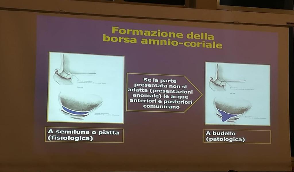 (quando amnios e corion sono adese alla decidua si parla di MEMBRANE AMNIO CORIALI, quando invece si distaccano dalla decidua si parla di BORSA AMNIO CORIALE) La borsa amnio coriale a seconda dell