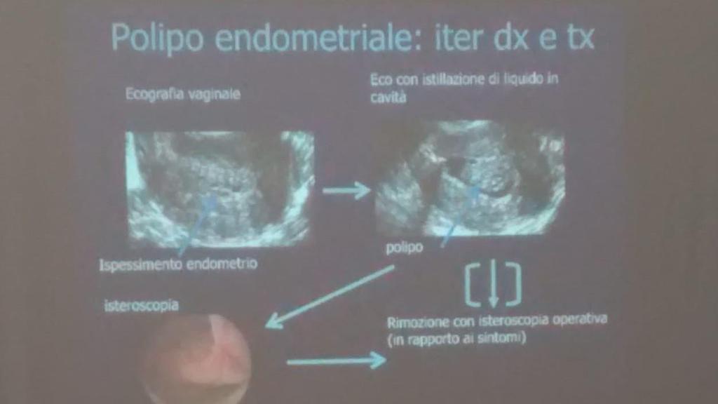 Lez. 13 TUMORI del CORPO dell'utero e dell'ovaio (Messalli) 29/11/18 I Tumori dell'utero si distinguono in benigni e maligni.