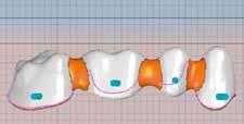 I restauri con ponti interamente anatomici o parzialmente ridotti devono essere posizionati in modo tale che la superficie minima indicata per i connettori si trovi nell area dentinale, cioè al di