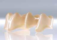 Esempio di dente posteriore Procedimento pratico Tecnica di stratificazione Dopo la