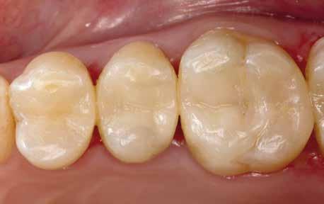 naturale della luce. Ciò facilita la riproduzione del dente naturale e crea contemporaneamente un equilibrato effetto camaleonte sia nella dentina che nello smalto.