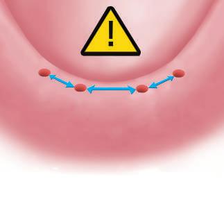 monoimpianti per overdenture O-ring 1. PREPARAZIONE DEL SITO IMPLANTARE La tipologia e la sede dell accesso chirurgico sono scelte dal professionista in base ai parametri clinico-morfologici rilevati.