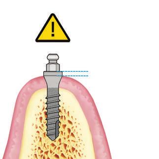 La profondità di lavoro è visivamente indicata dalle bande nere con rivestimento DLC (Diamond-Like Carbon) presenti sulla fresa.