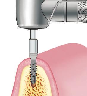 monoimpianti per overdenture O-ring 3.