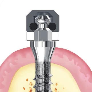 micro cuffia con micro O-ring ANELLO PER MONOIMPIANTI 4.4 Inserire in bocca al paziente la protesi e controllare che la sua inserzione sia libera da frizioni e contatti indesiderati.